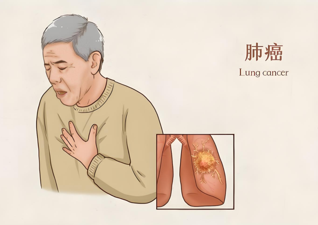 家族史≠宿命 吸烟才是“头号元凶”！专家：40岁以上重度吸烟者应年检CT