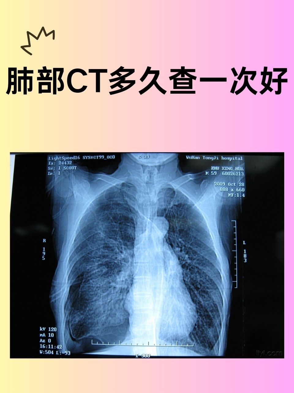家族史≠宿命 吸烟才是“头号元凶”！专家：40岁以上重度吸烟者应年检CT