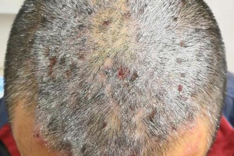 武田制药公布银屑病新药临床研究结果 每日一次口服方案有望实现皮损清除