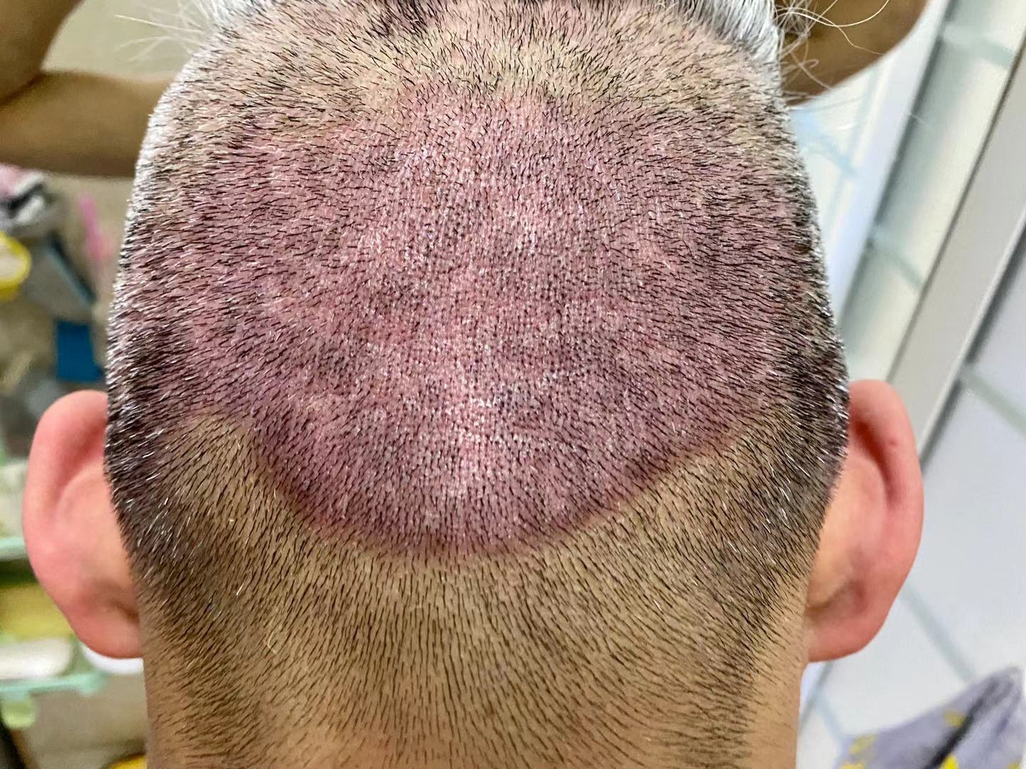 武田制药公布银屑病新药临床研究结果 每日一次口服方案有望实现皮损清除