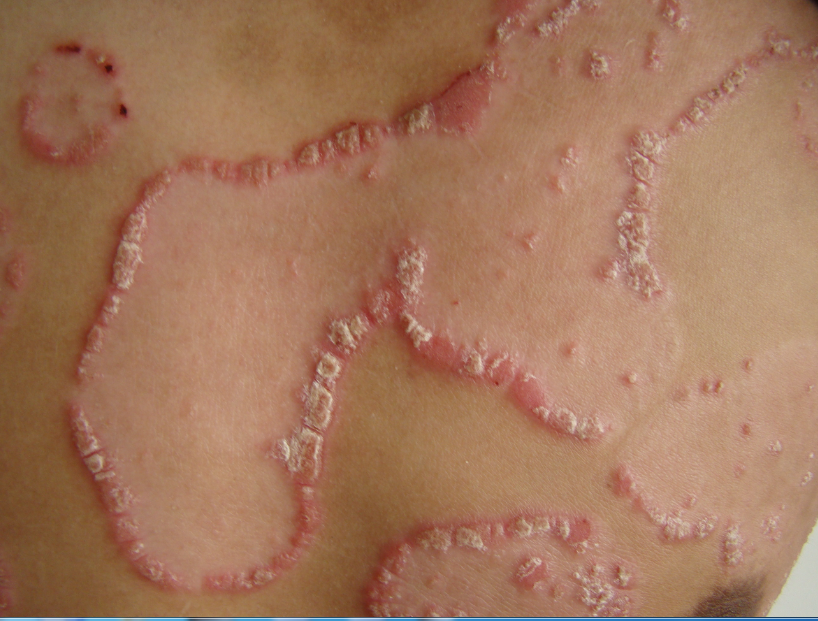 武田制药公布银屑病新药临床研究结果 每日一次口服方案有望实现皮损清除